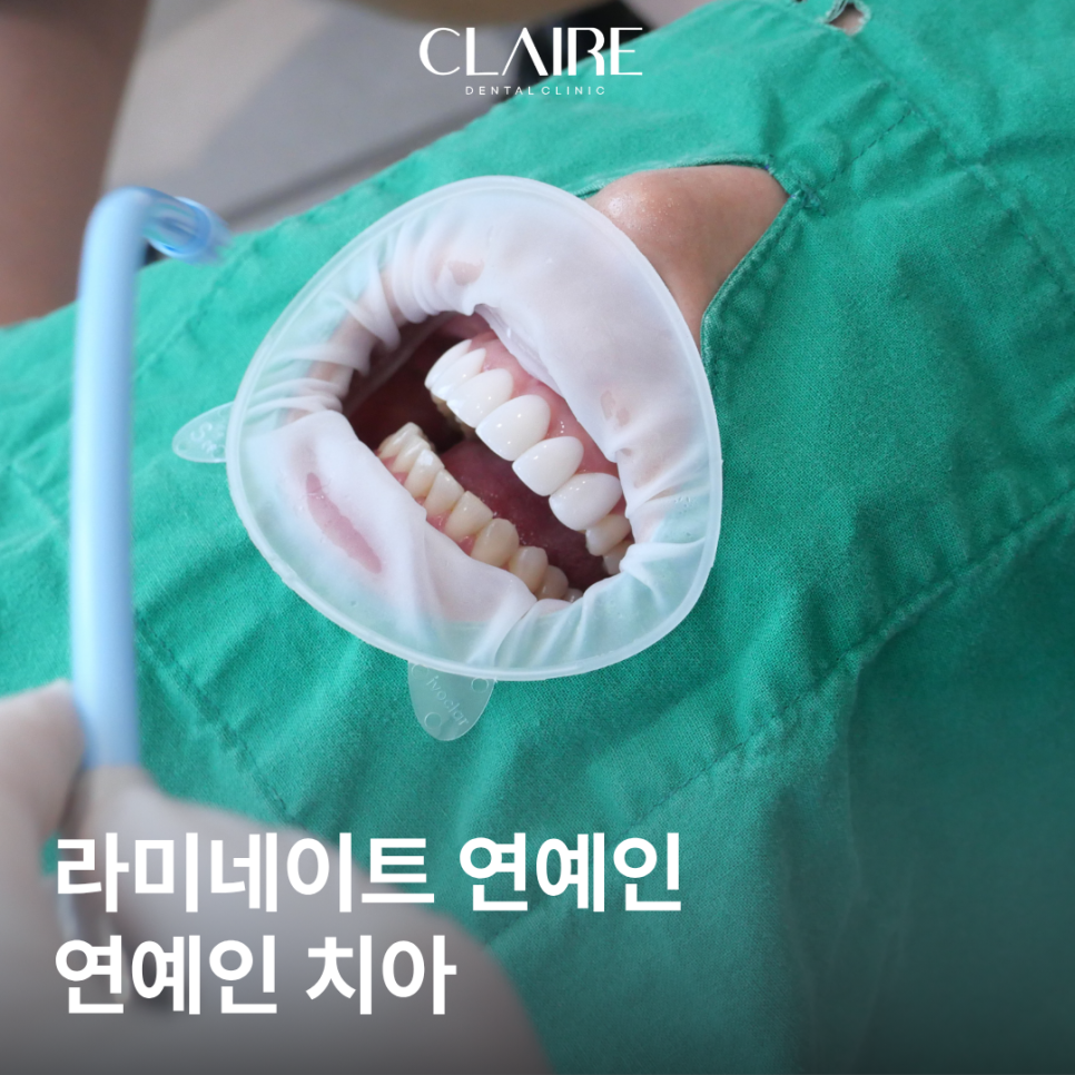 선릉역 라미네이트 연예인 무삭제 후기 예쁜 치아 믿어도 될까? 관련 이미지 1