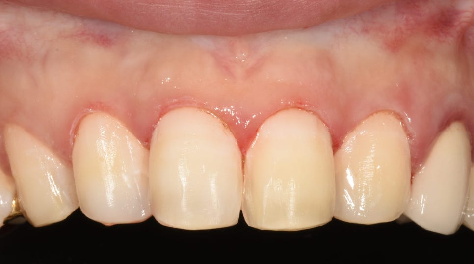 교정은 너무 오래 걸려요. 라미네이트로 빨리 가능할까요? 관련 이미지 4