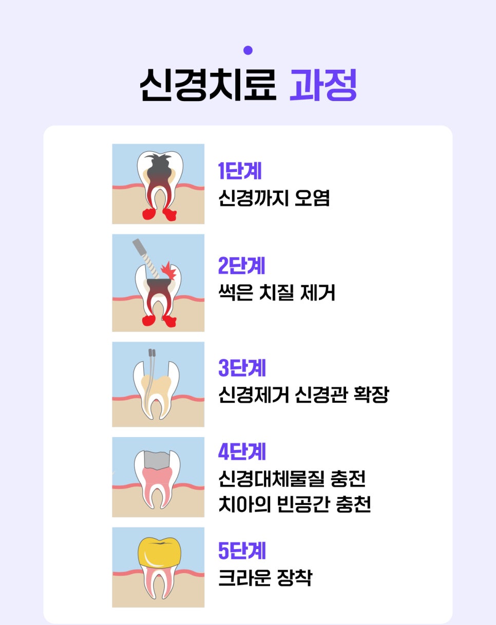 치아를 살리는 마지막 선택, 신경치료 관련 이미지 1