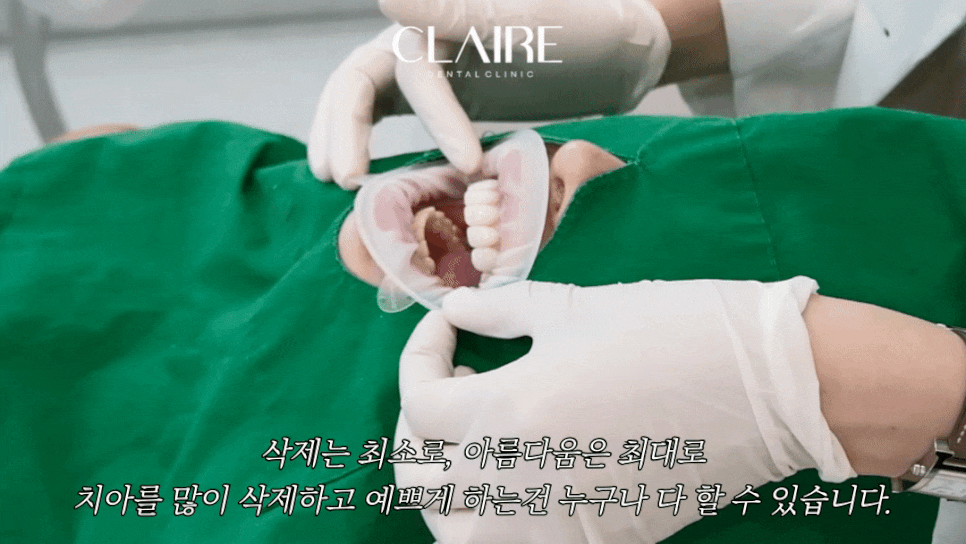 깨진 치아 이가 깨졌을때 예쁘게 복원 가능할까? 관련 이미지 2