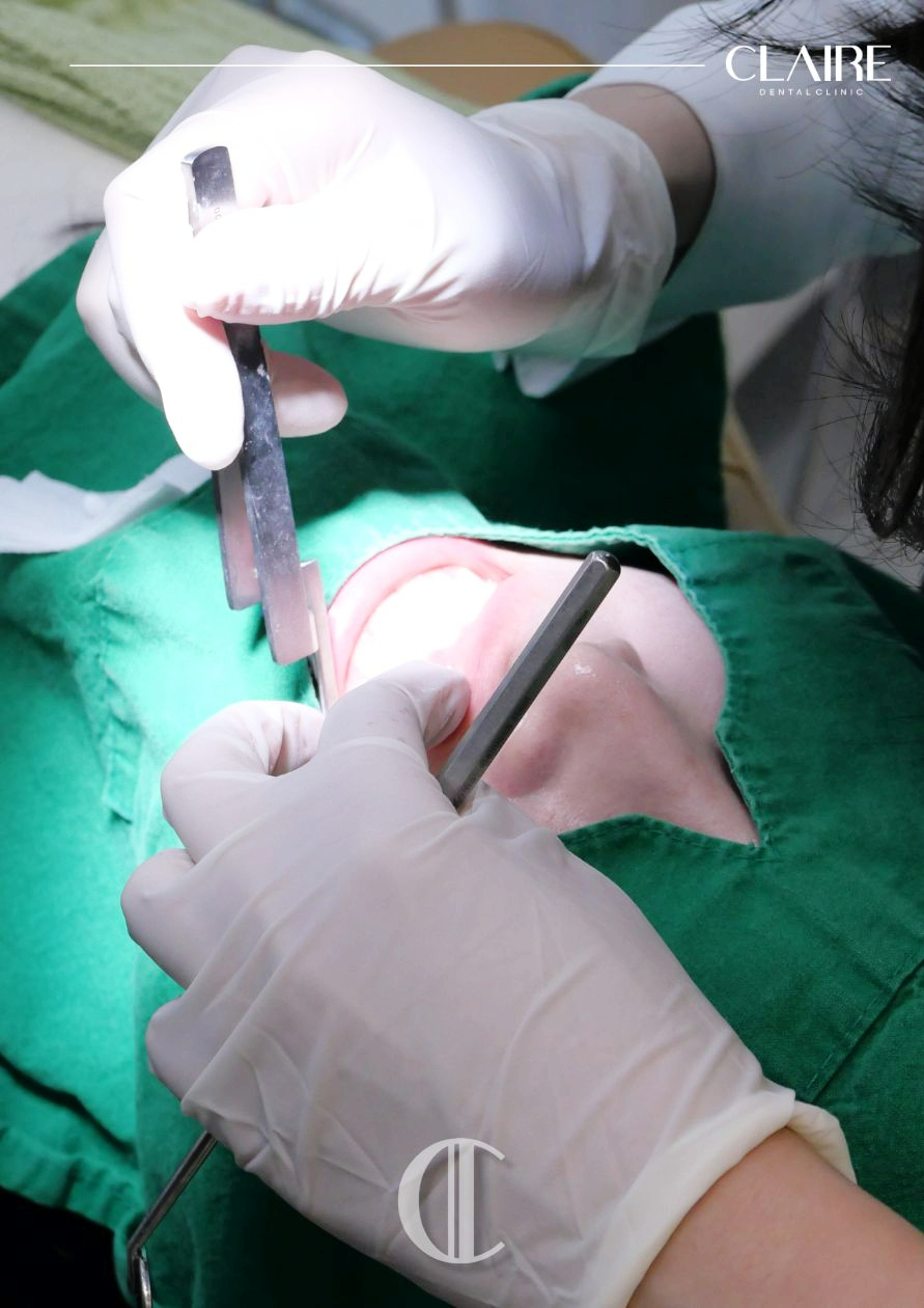 앞니 크라운 교체 가격 강남 무삭제 라미네이트 치과 선택은? 관련 이미지 5