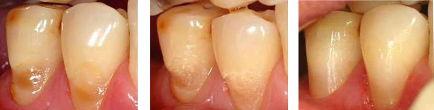 Gangnam Dental Clinic: What Should You Do If You Have Tooth Sensitivity? image 1