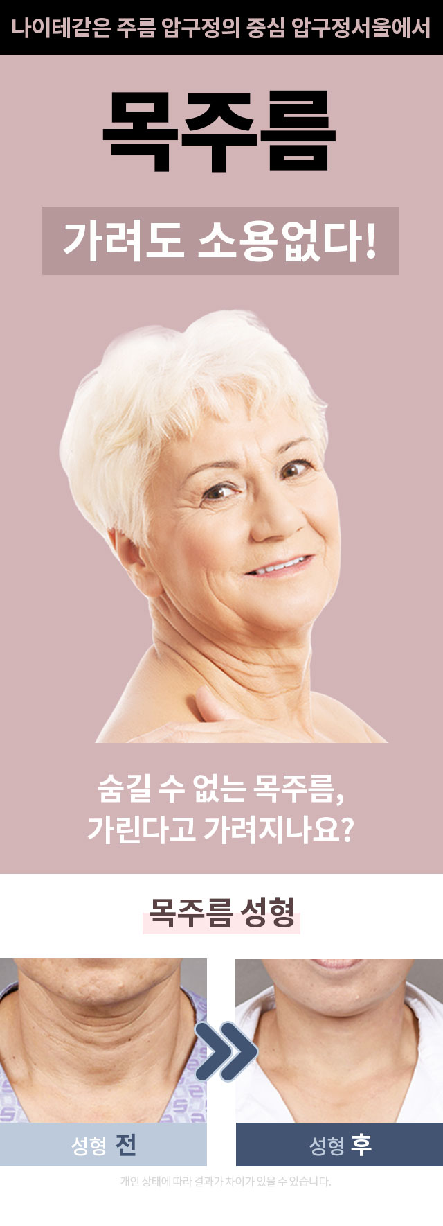 압구정성형외과 목주름 관련 이미지 1