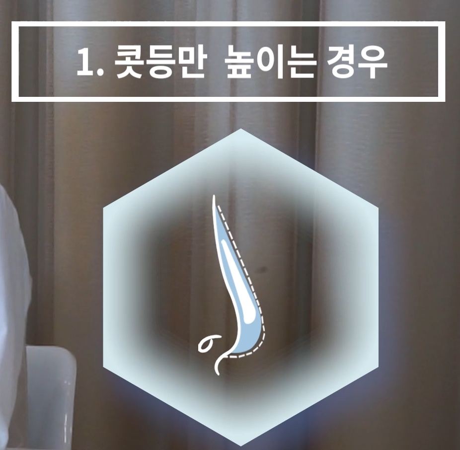 개방형 비개방형 코수술 차이점 장단점까지 한눈에 정리 관련 이미지 3
