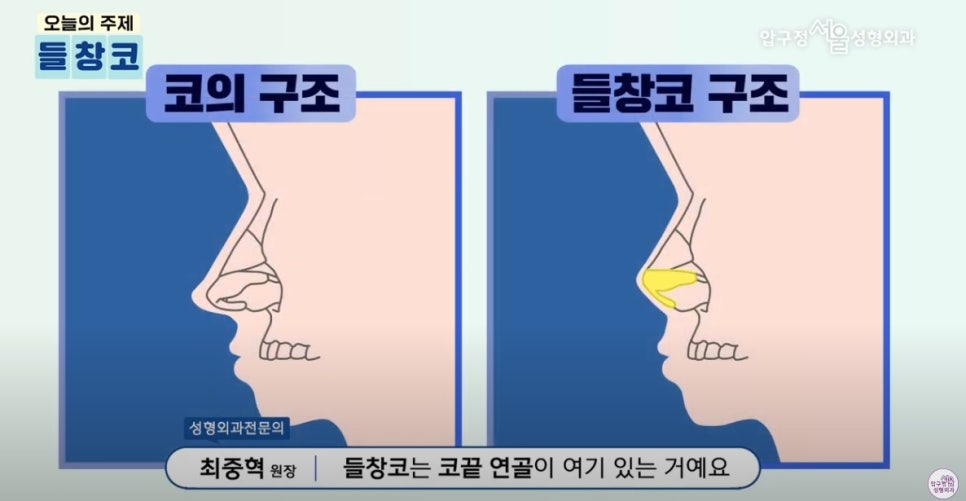 Apgujeong Plastic Surgery Nose Revision: Upturned Nose Causes and Surgery Review image 2