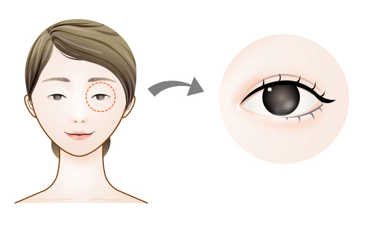 눈매교정과 쌍수 똑같은 줄 아셨나요? 관련 이미지 2