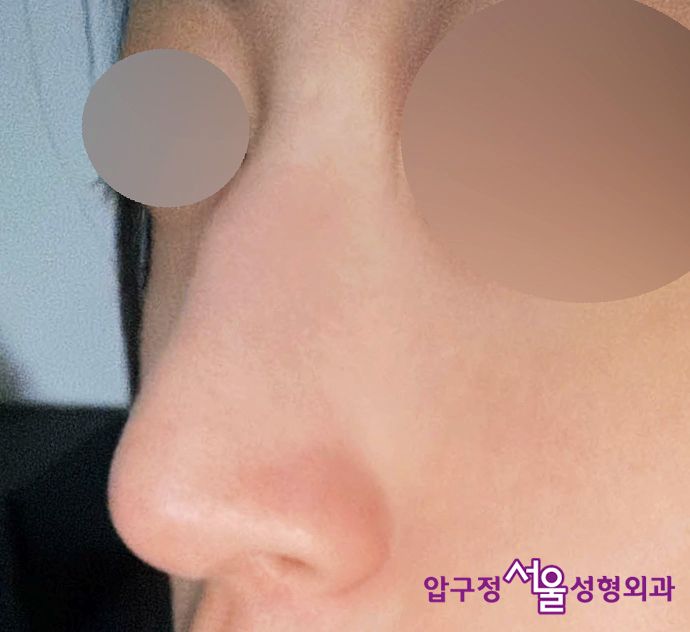 압구정 무보형물 코수술로 효과보는 매부리코 유형 관련 이미지 3