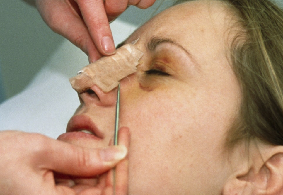 Why Are Cotton Packing and a Splint Used After Rhinoplasty at Seoul Apgujeong Plastic Surgery? Postoperative Care Methods image 1