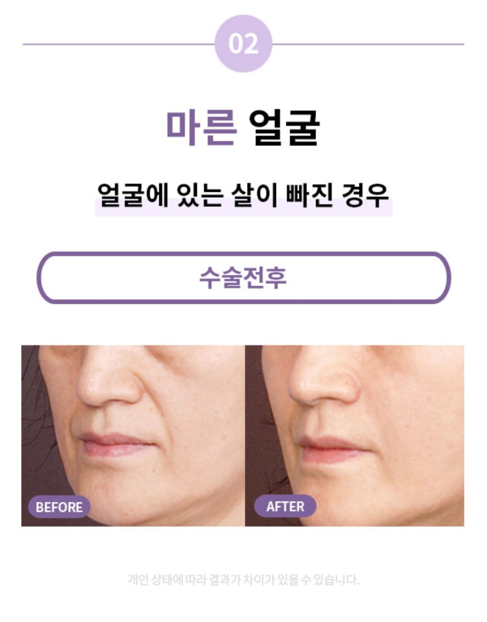 "SMAS Facelift" to Firmly Restore Sagging Jowls and Nasolabial Folds image 6