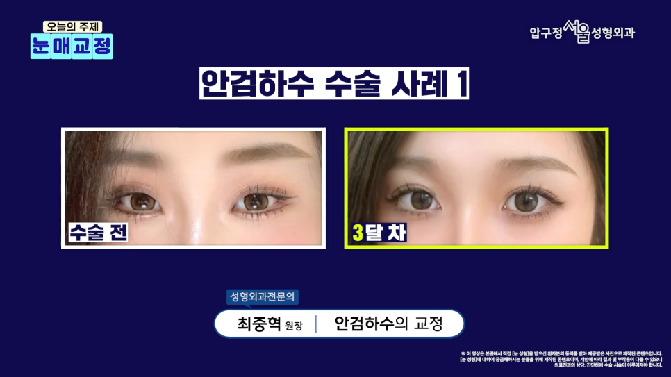 압구정서울성형외과 안검하수 수술 후기 비교│절개vs비절개 선택 기준 관련 이미지 5