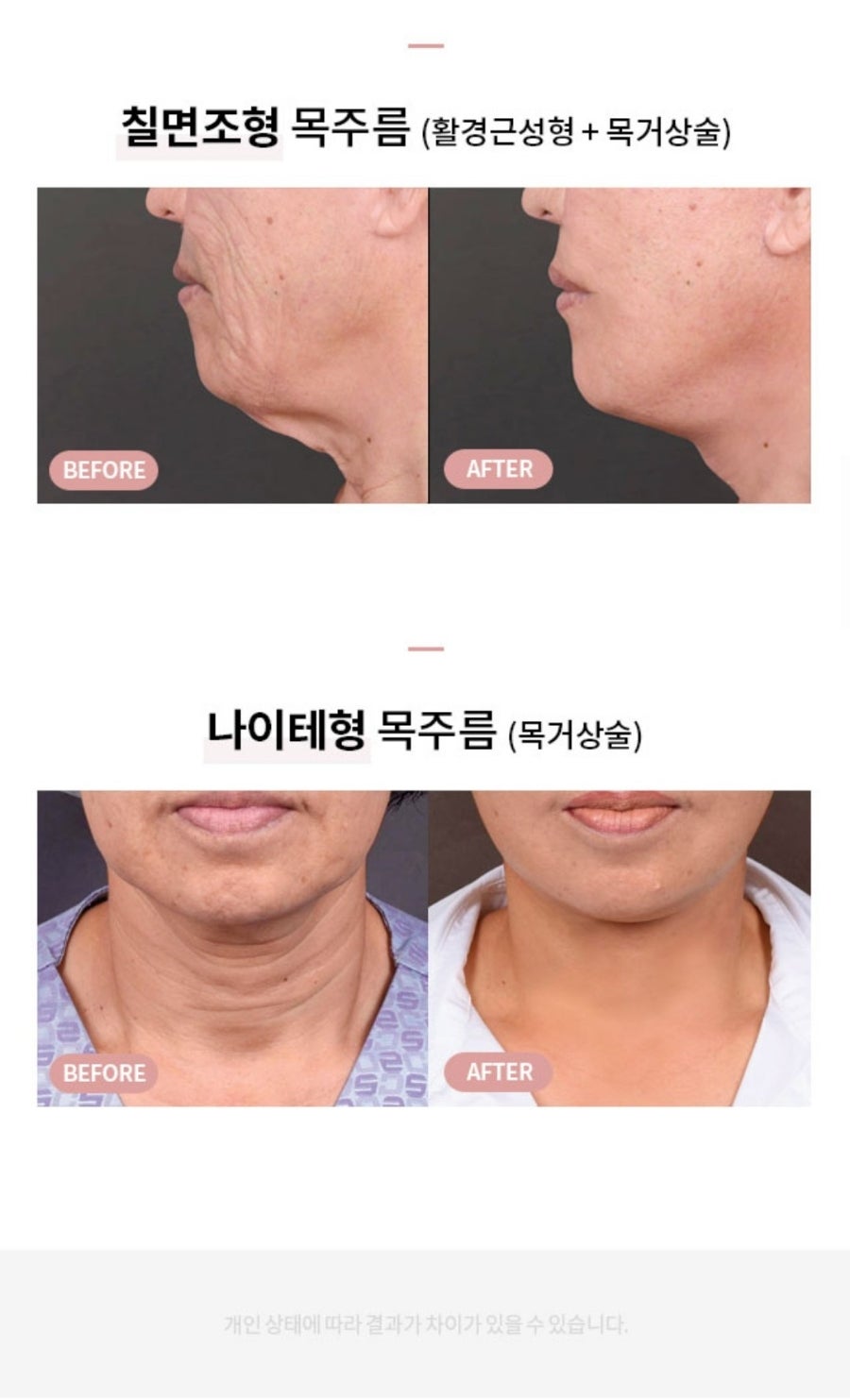 나이테같은 목주름을 확실히 당겨주는 방법은? "목거상술" 관련 이미지 5