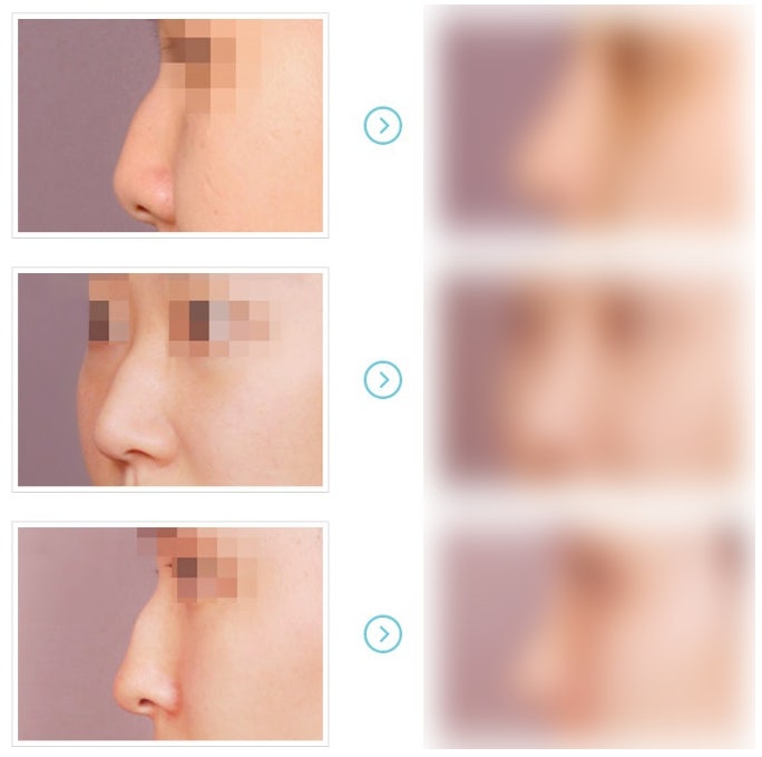 매부리코 뜻, 압구정서울성형외과 남자, 여자 매부리코 교정 성형수술 방법 (매부리코 연예인) 관련 이미지 9