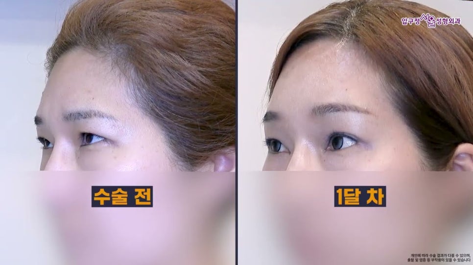 40대 이마거상수술 전후 궁금하다면? 내시경 이마거상술 체크포인트 관련 이미지 1