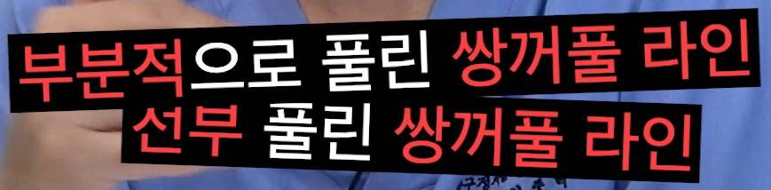 압구정 눈재수술 눈성형 눈수술의 모든 것, 압구정서울성형외과 관련 이미지 17