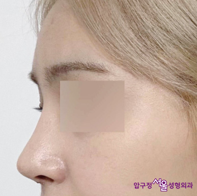 Apgujeong Plastic Surgery Review: Improved Hump Nose with a Straight Nose Line image 4