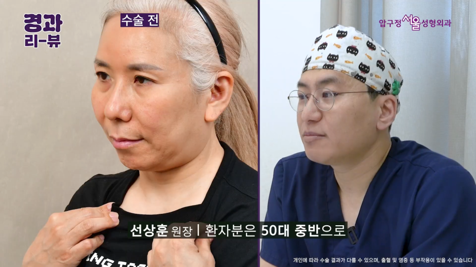 안면거상 전후 후기 압구정서울성형외과 실제 케이스 비교 분석 관련 이미지 2