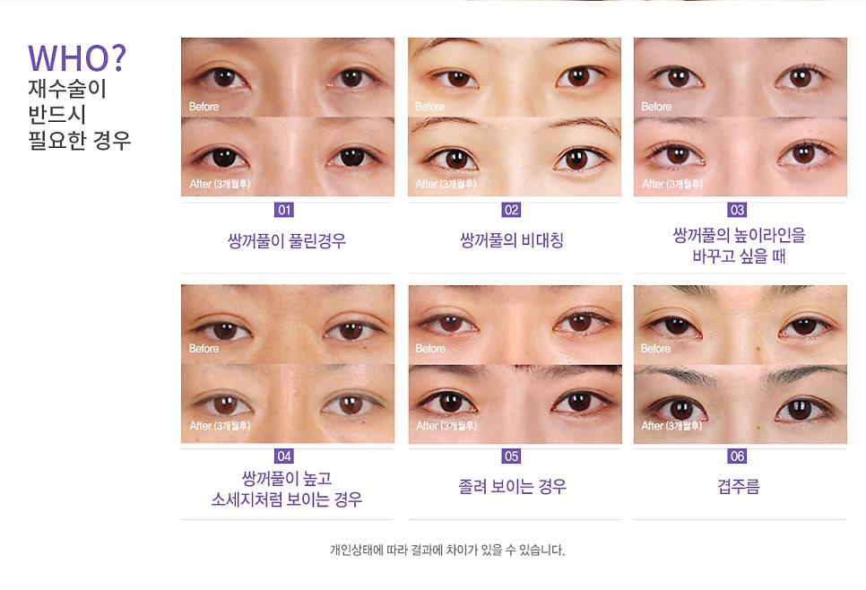 Apgujeong Seoul Plastic Surgery: Revision Eyelid Surgery Methods and Reviews by Type image 1