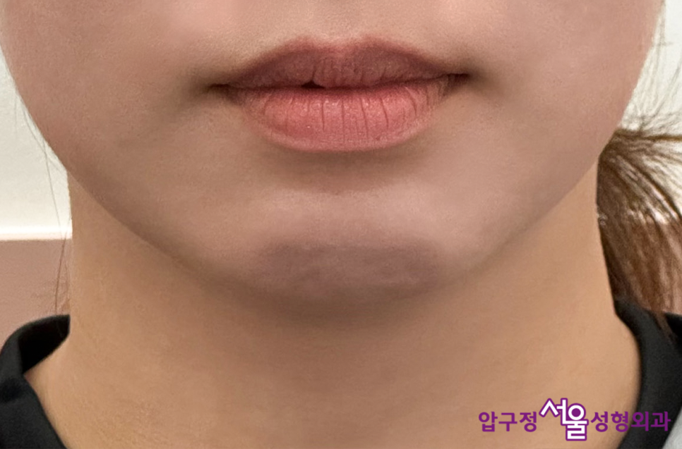What Is a Retruded Chin? Chin Implant Surgery for Chin Correction at Apgujeong Seoul Plastic Surgery image 12