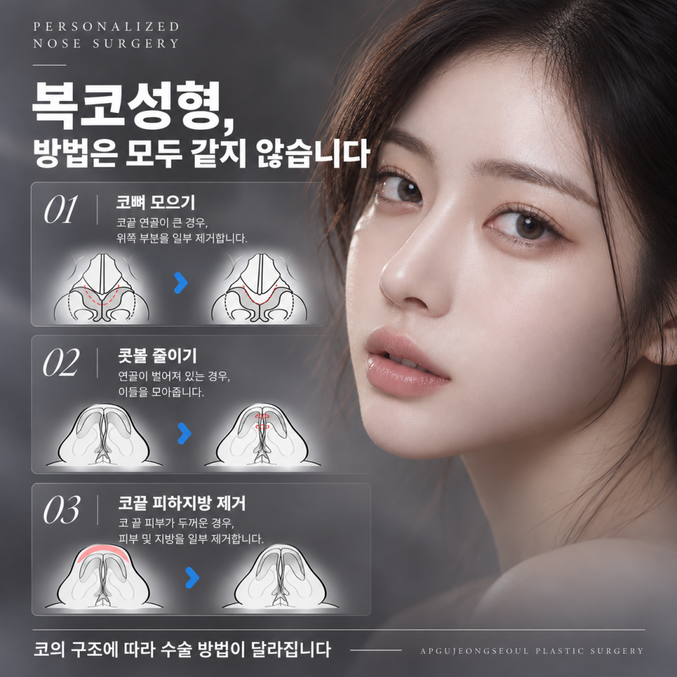 "뭉툭한 코끝 원인과 수술 방법은?" 복코성형 압구정서울성형외과 관련 이미지 4