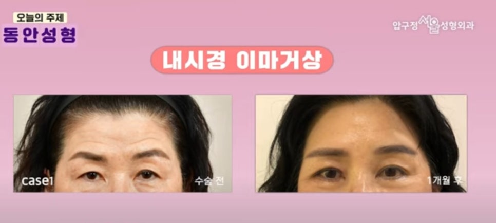 Seoul Plastic Surgery Recommendation: Still Debating It? image 4