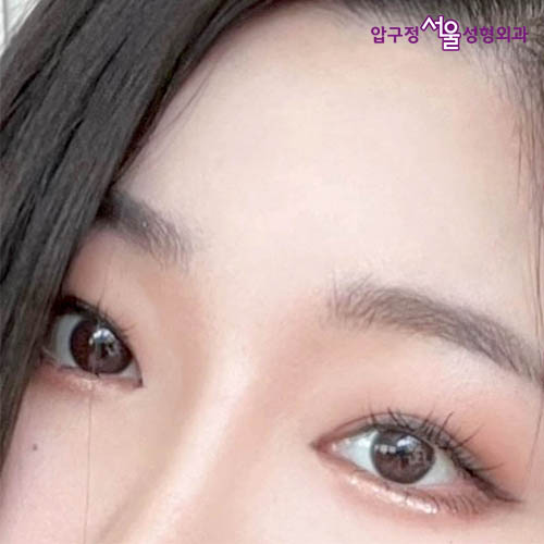 [Apgujeong Seoul Plastic Surgery] Non-incisional Eye Correction for Clearer, More Defined Eyes image 2