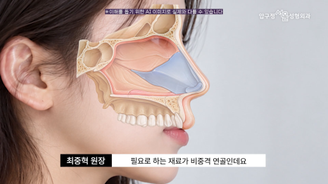 기능코수술 압구정서울성형외과 코막힘과 코 모양을 함께 고려한다면 관련 이미지 8