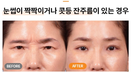 Worried About Forehead Wrinkles? A Quick Overview of Men’s Forehead Lifts and Forehead Lift Surgery Costs image 7