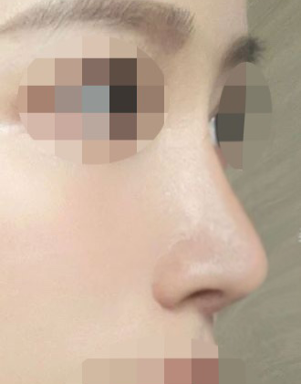 IU’s Small Nose and Low Nasal Bridge Surgery at Apgujeong Seoul Plastic Surgery image 9