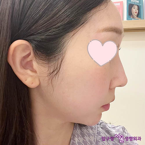 [Apgujeong Seoul Plastic Surgery] Natural Straight Line Improvement After Hump Nose Surgery! image 1