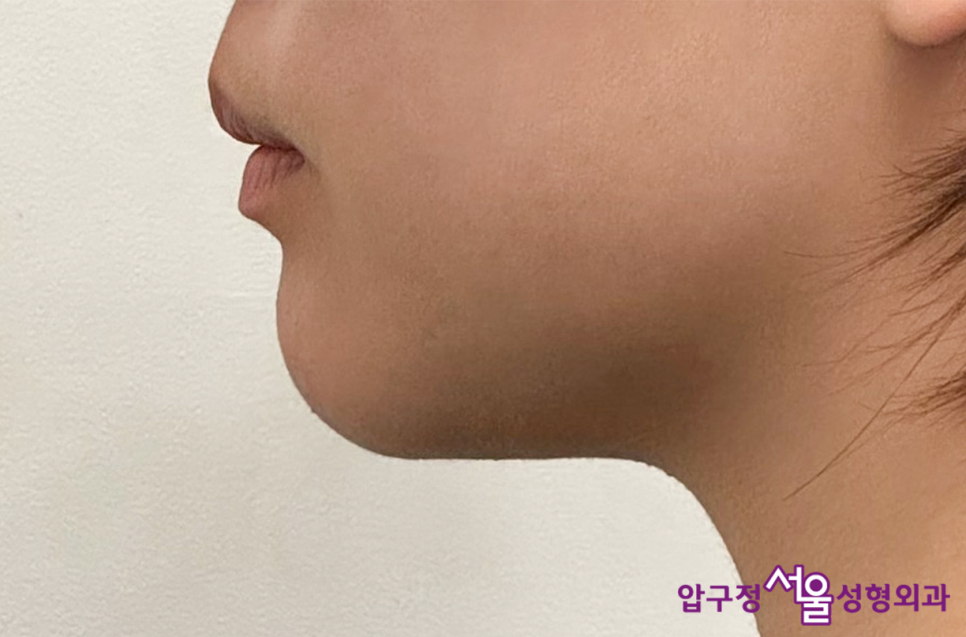What Is a Retruded Chin? Chin Implant Surgery for Chin Correction at Apgujeong Seoul Plastic Surgery image 15