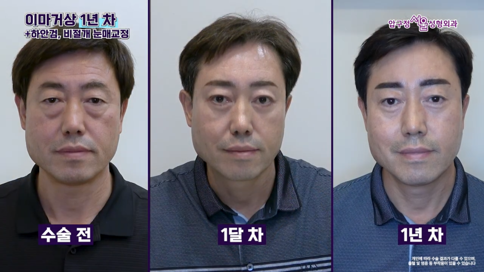 남자 이마거상 1년 후 실제 후기와 수술 전 알아야 할 핵심 포인트 관련 이미지 4