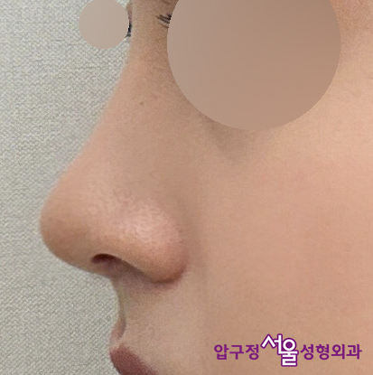 Apgujeong Seoul Plastic Surgery: The Effect of Nasolabial Angle Rhinoplasty (Shin Se-kyung, Minji) image 5
