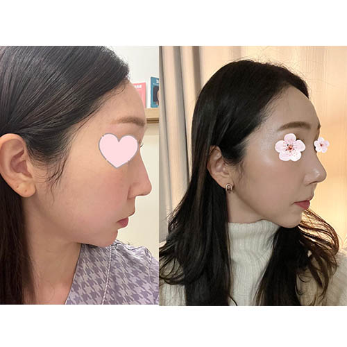 [Apgujeong Seoul Plastic Surgery] Natural Straight Line Improvement After Hump Nose Surgery! image 5