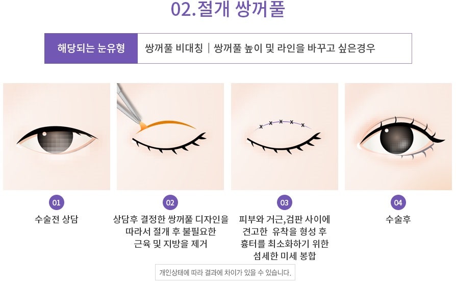 Apgujeong Seoul Plastic Surgery: Revision Eyelid Surgery Methods and Reviews by Type image 4