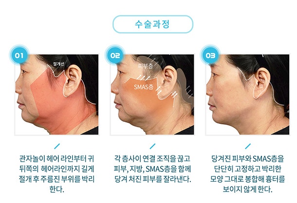 Brad Pitt Facelift?! The Secret to Looking Younger: Youthful Plastic Surgery Facelift, Apgujeong Seoul Plastic Surgery image 3