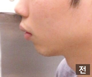 A Good Place for Chin Surgery: Apgujeong Seoul Plastic Surgery image 2