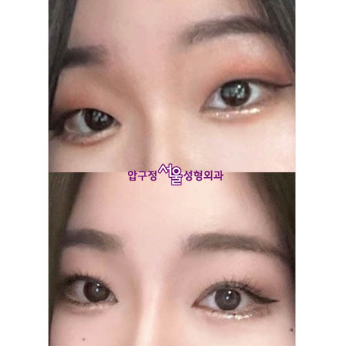 [Apgujeong Seoul Plastic Surgery] Non-incisional Eye Correction for Clearer, More Defined Eyes image 5