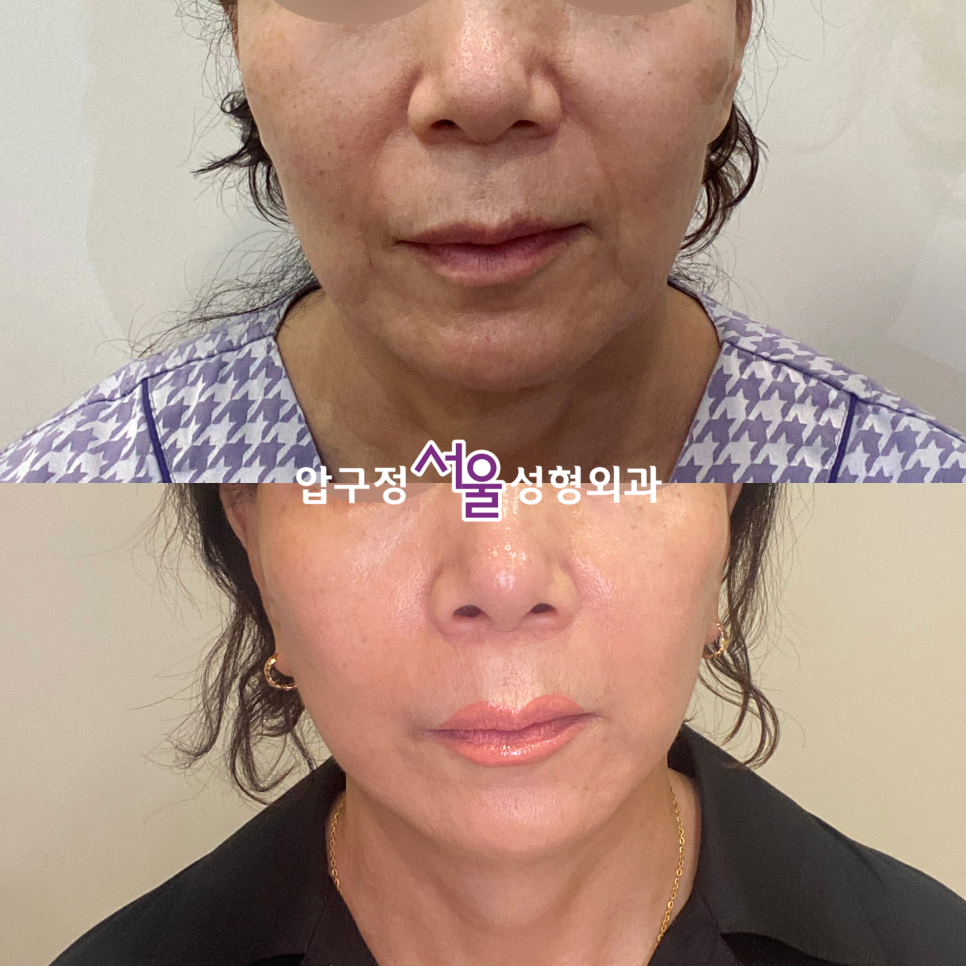 Curious About Reviews of a Clinic That Does Facelift Surgery Well at Apgujeong Seoul Plastic Surgery? image 8