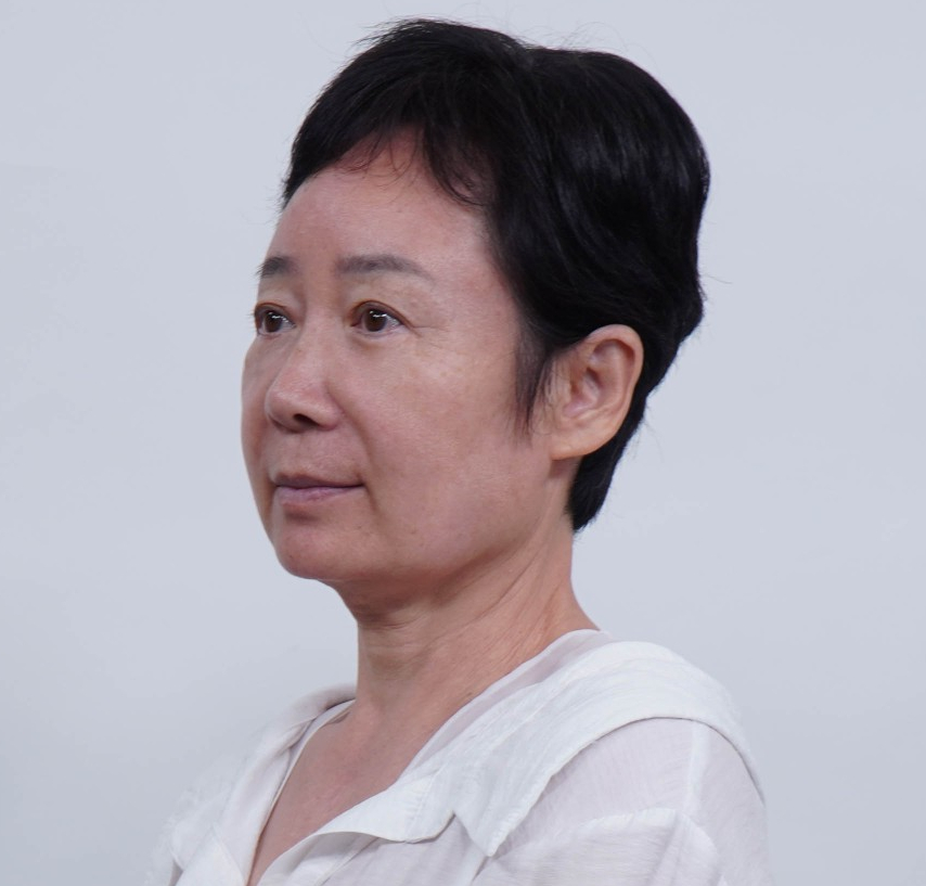 A Dramatic Transformation for Brighter, Clearer Eyes: A 5-Year Follow-Up Review of Forehead Lift Surgery in Your 60s image 10