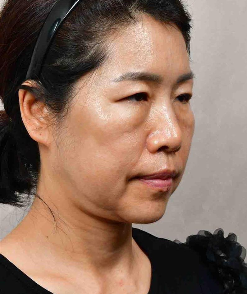 [압구정서울성형외과] 50대 이마거상, 안면거상, 하안검 후기 관련 이미지 2