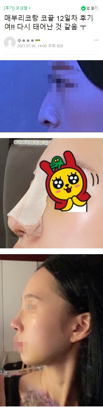 Escape from a Low Nasal Bridge at Apgujeong Seoul Plastic Surgery! image 3
