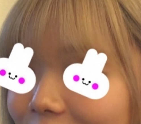 Apgujeong Bulbous Nose and Straight-Bridge Line Rhinoplasty Review image 2