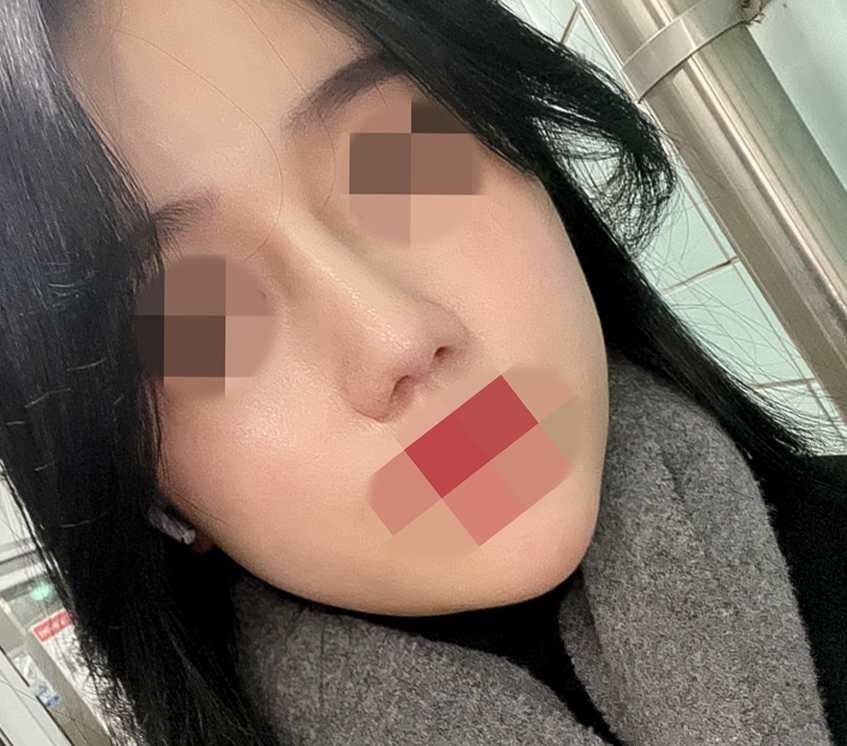 압구정서울성형외과 설윤 직선라인 자려한코성형 최중혁원장님 관련 이미지 7