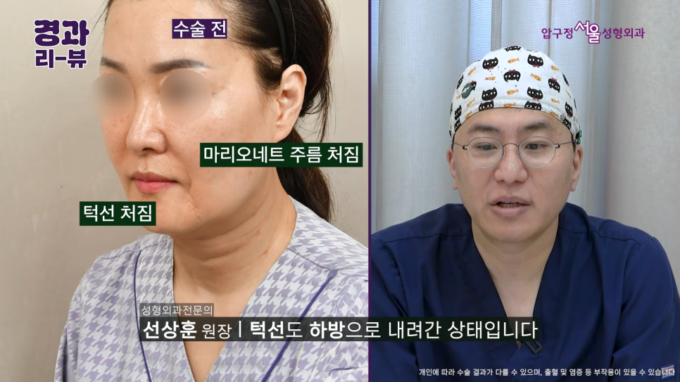 50대 안면거상 후기 팔자주름부터 목주름까지 어떻게 달라질까? 관련 이미지 3