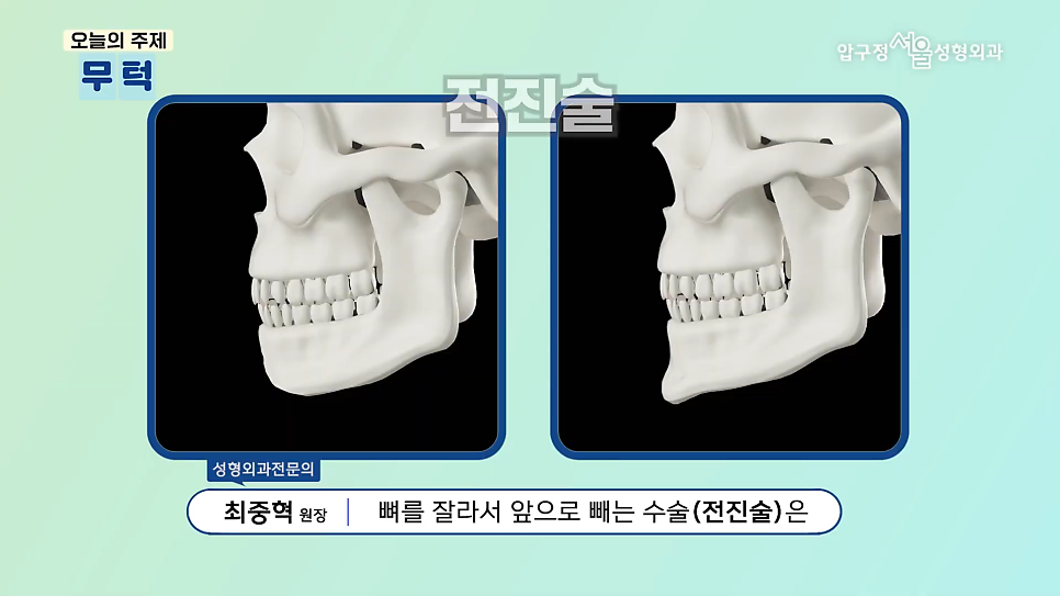 What Is a Retruded Chin? Chin Implant Surgery for Chin Correction at Apgujeong Seoul Plastic Surgery image 9