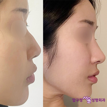 Natural Rhinoplasty Review for a Hump Nose with Septal Deviation in Apgujeong image 4