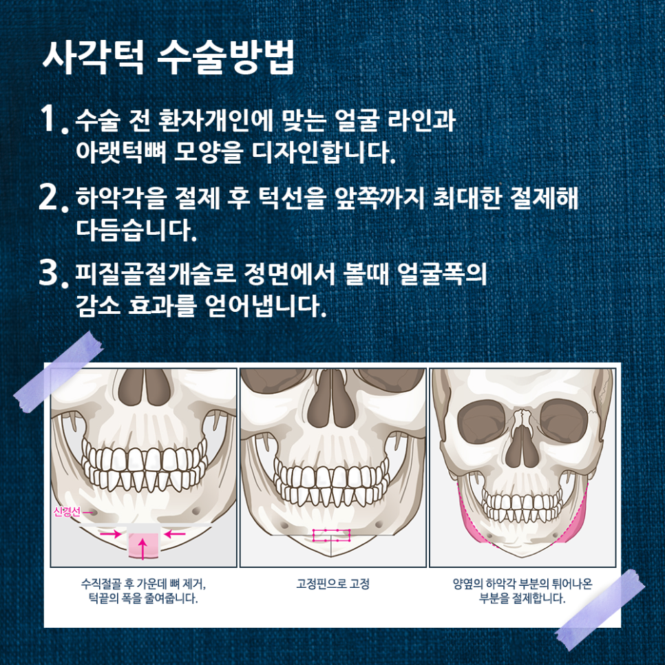 압구정서울성형외과 사각턱이 고민이라면? 클릭! 관련 이미지 4