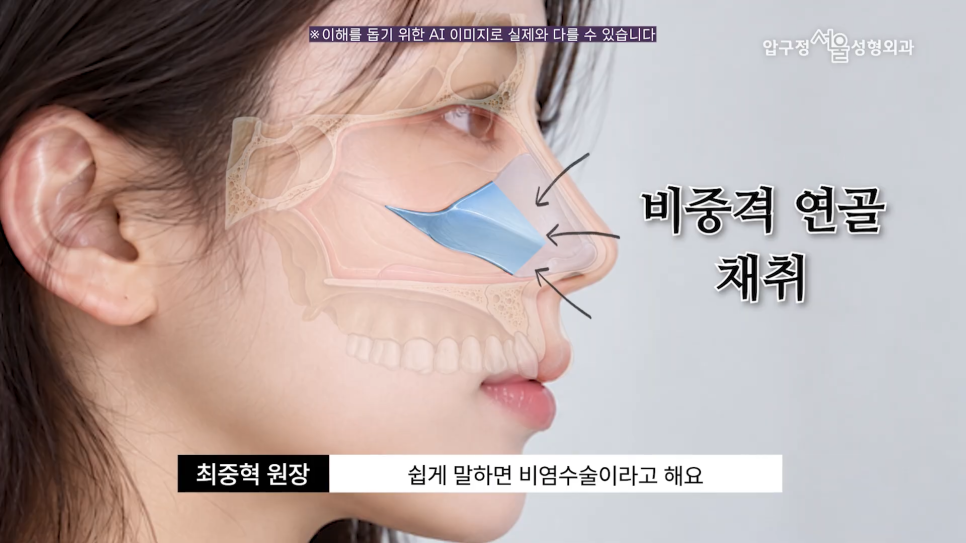 기능코수술 압구정서울성형외과 코막힘과 코 모양을 함께 고려한다면 관련 이미지 9