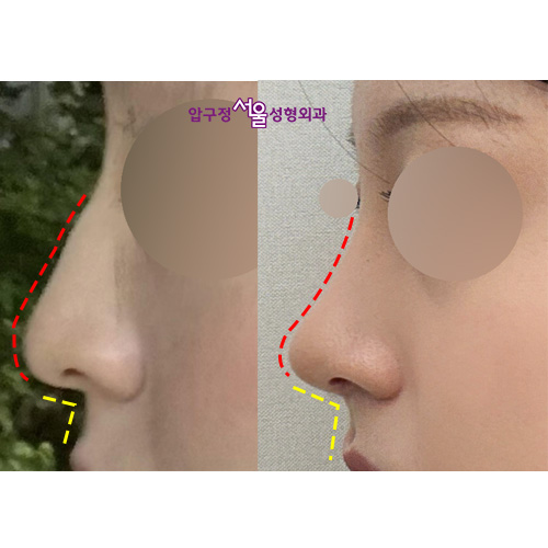 Apgujeong Seoul Plastic Surgery: The Effect of Nasolabial Angle Rhinoplasty (Shin Se-kyung, Minji) image 6