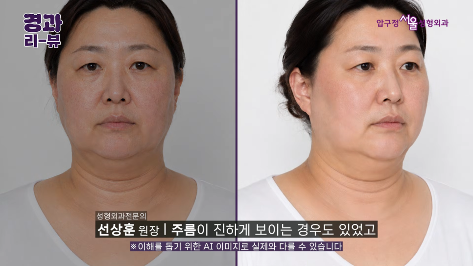 50대 안면거상 후기 팔자주름부터 목주름까지 어떻게 달라질까? 관련 이미지 5